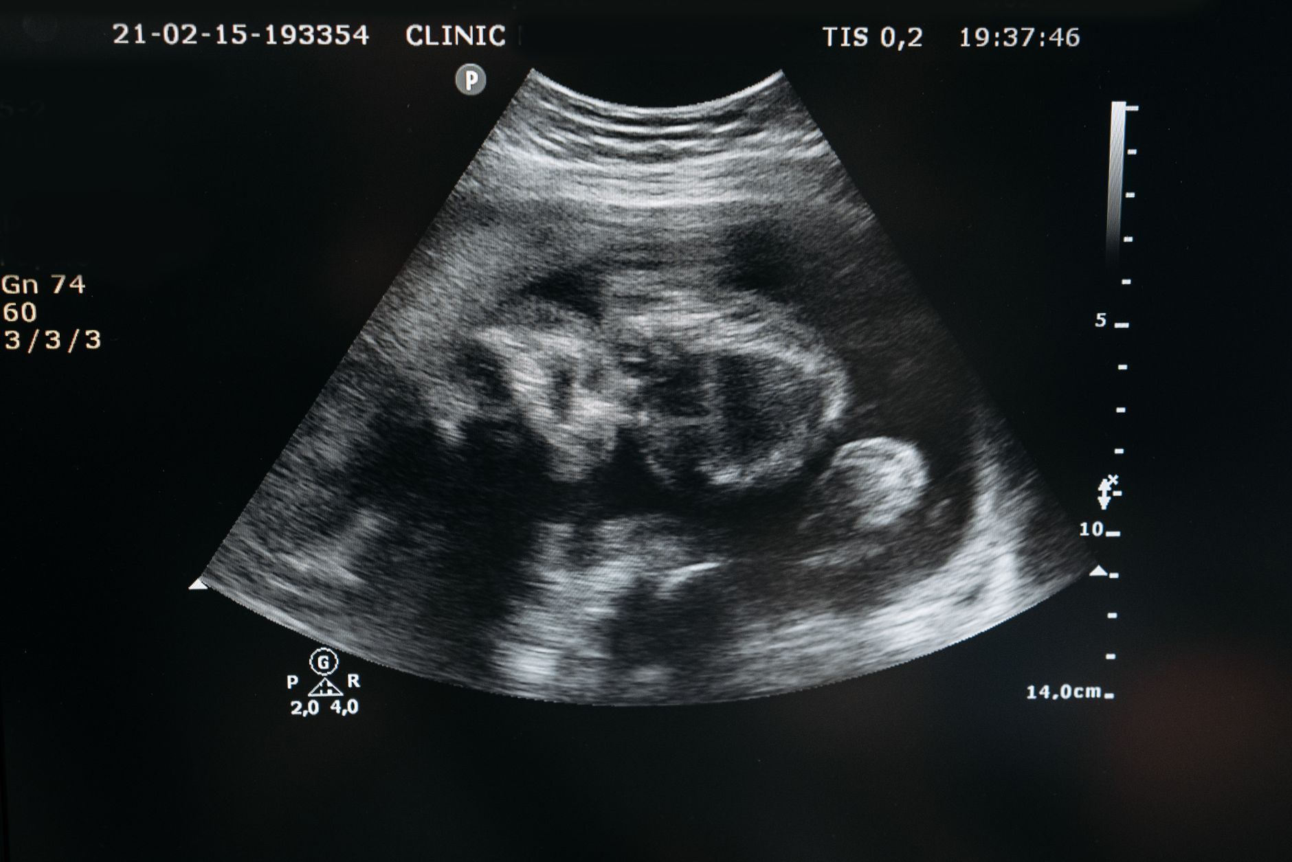 Baby ultrasound scan during pregnancy